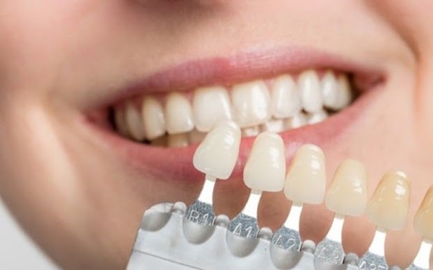 Dán răng sứ là gì? Ưu nhược điểm như thế nào?